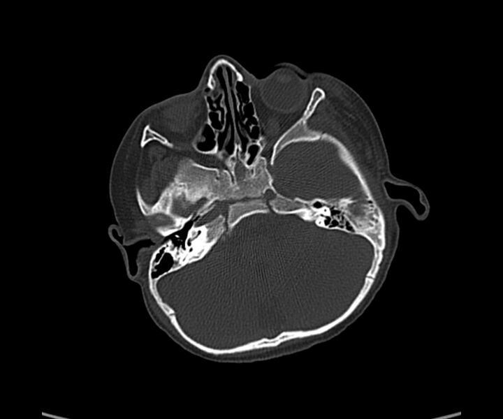 File:Acute hemorrhagic contusion (Radiopaedia 63660-72336 Axial bone window 17).jpg