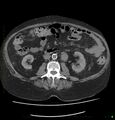 Acute renal failure post IV contrast injection- CT findings (Radiopaedia 47815-52559 Axial C+ portal venous phase 40).jpg