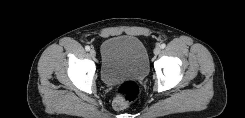 Acute sigmoid colon diverticulitis (Radiopaedia 55507-61976 Axial C+ portal venous phase 111).jpg