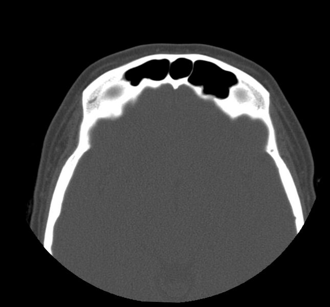 File:Acute sinusitis (Radiopaedia 22419-22455 Axial non-contrast 29).jpg