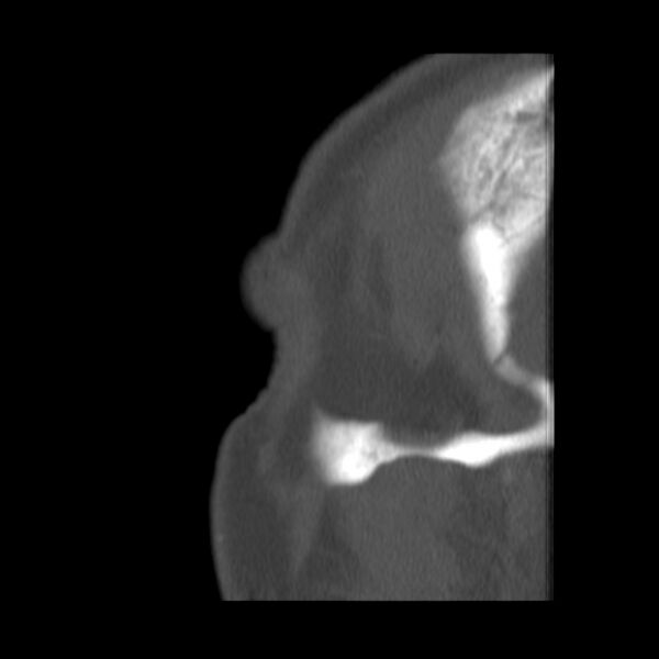 File:Acute sinusitis (Radiopaedia 23161-23215 Sagittal bone window 4).jpg