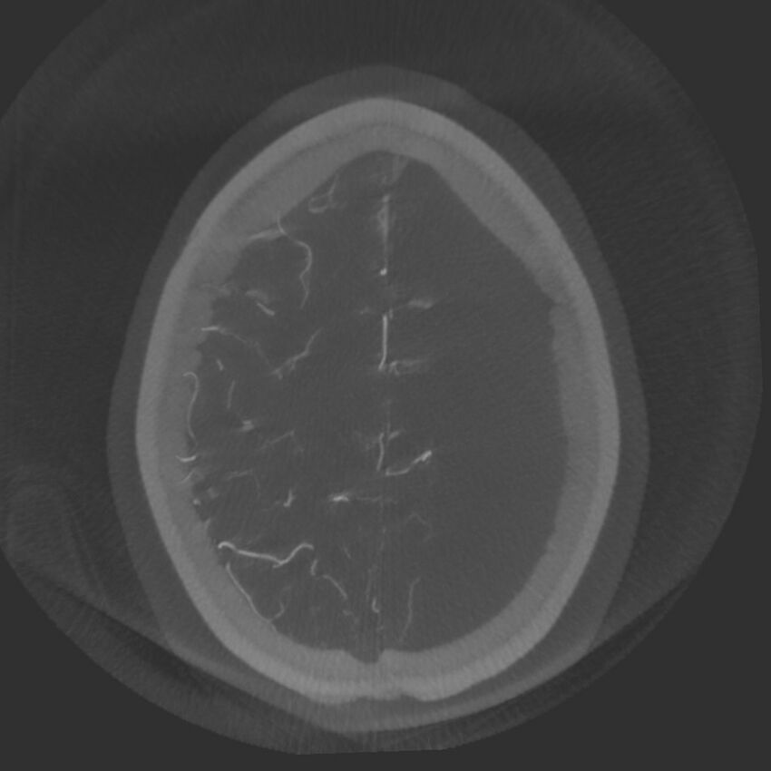 Acute subarachnoid hemorrhage and accessory anterior cerebral artery (Radiopaedia 69231-79010 Axial arterial - MIP 71).jpg