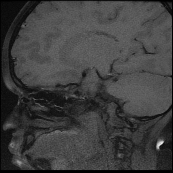 File:Adamantinomatous craniopharyngioma (Radiopaedia 77407-89529 Sagittal T1 fat sat 2).jpg