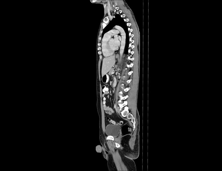File:Addison disease (Radiopaedia 49318-54412 Sagittal C+ portal venous phase 29).jpg