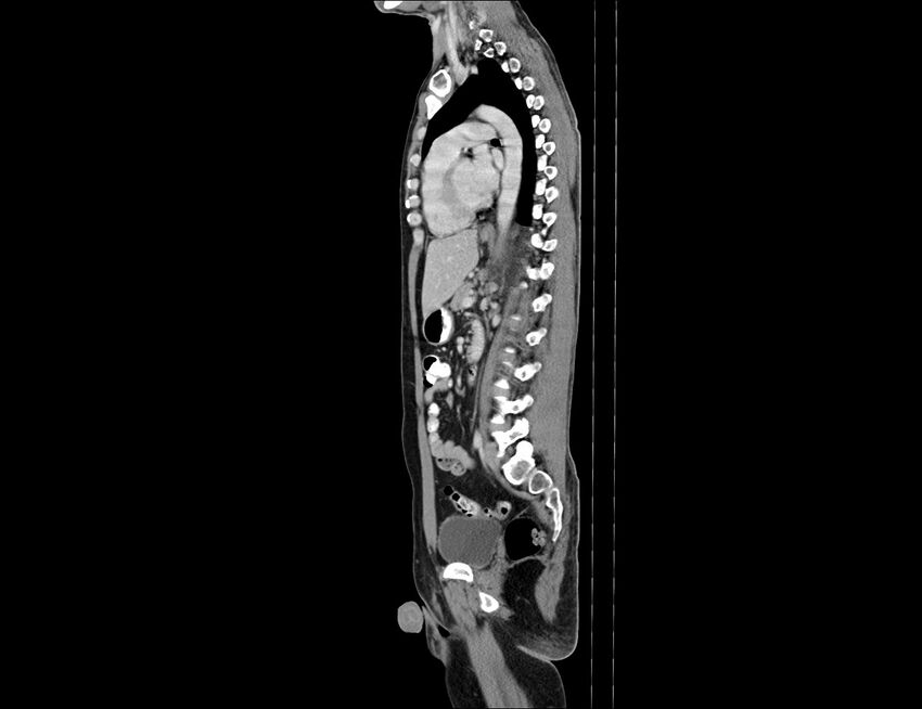Addison disease (Radiopaedia 49318-54412 Sagittal C+ portal venous phase 29).jpg