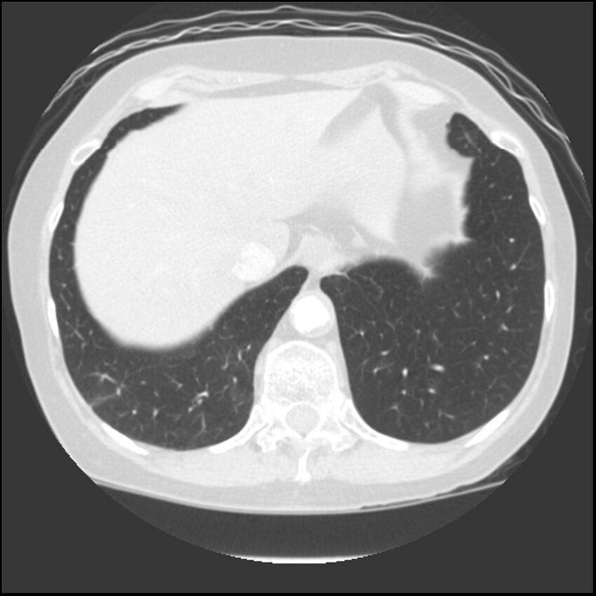 Adenocarcinoma of the lung (Radiopaedia 41015-43755 Axial lung window 105).jpg