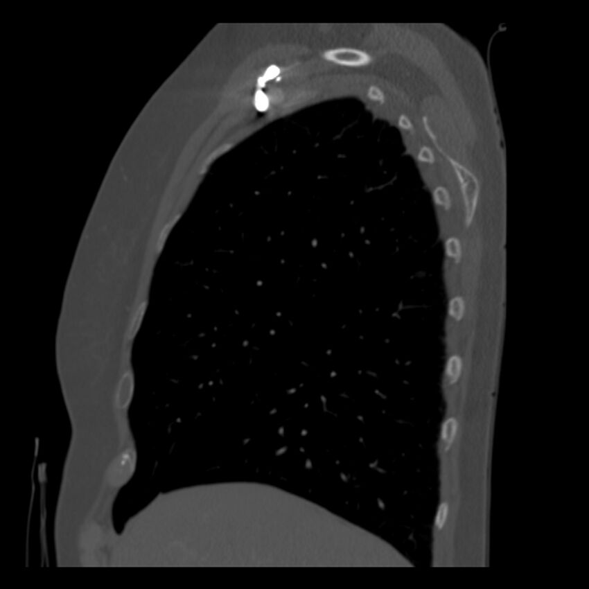 Adenocarcinoma of the lung (Radiopaedia 41015-43755 Sagittal bone window 19).jpg