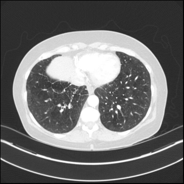File:Adenocarcinoma of the lung (Radiopaedia 44205-47803 Axial lung window 68).jpg