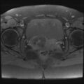 Adenomyosis and endometriotic cysts (Radiopaedia 82300-96367 Axial T1 fat sat 5).jpg