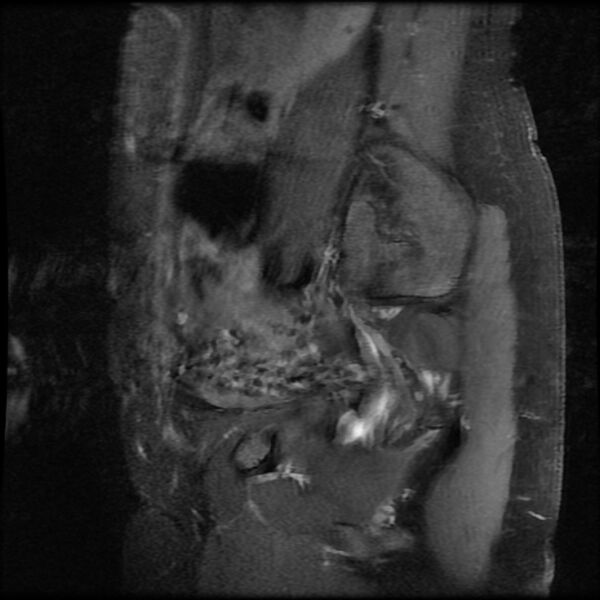 File:Adenomyosis on MRI (Radiopaedia 29328-29780 Sagittal T1 C+ fat sat 16).jpg