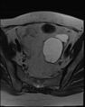 Adnexal multilocular cyst (O-RADS US 3- O-RADS MRI 3) (Radiopaedia 87426-103754 Axial T2 9).jpg