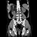 Adrenal myelolipoma (Radiopaedia 41843-44834 Coronal non-contrast 16).jpg