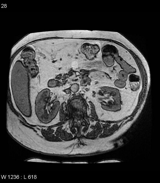 File:Adrenal myelolipoma (Radiopaedia 6765-7961 Axial T1 out-of-phase 28).jpg