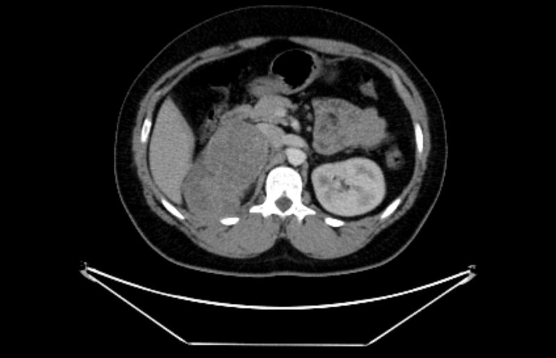 File:Adrenocortical carcinoma (Radiopaedia 80134-93438 Axial C+ portal venous phase 49).jpg