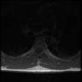 Aggressive vertebral hemangioma (Radiopaedia 39937-42404 Axial T1 26).png