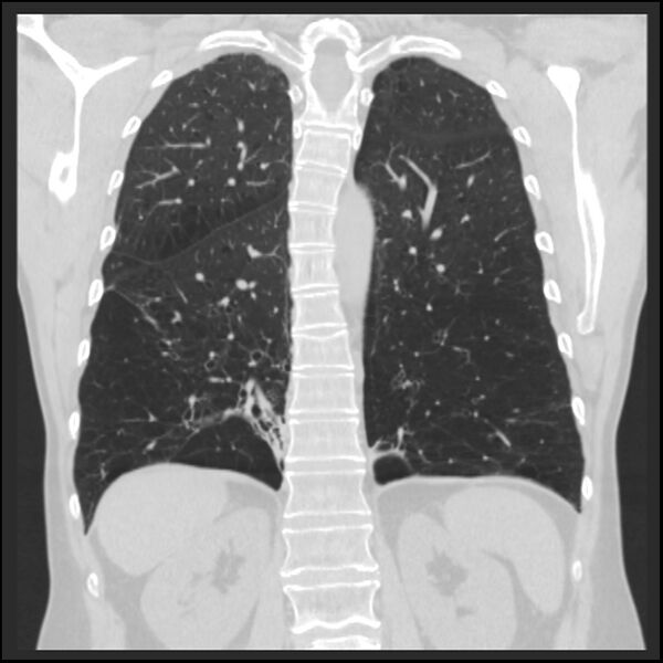 File:Alpha-1-antitrypsin deficiency (Radiopaedia 40993-43722 Coronal lung window 75).jpg