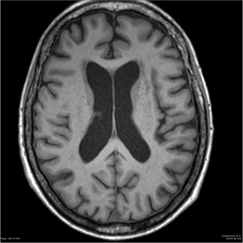 Alzheimer disease (Radiopaedia 22196-22226 Axial T1 39).jpg