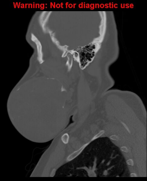 File:Ameloblastoma (Radiopaedia 33126-34164 Sagittal bone window 21).jpg