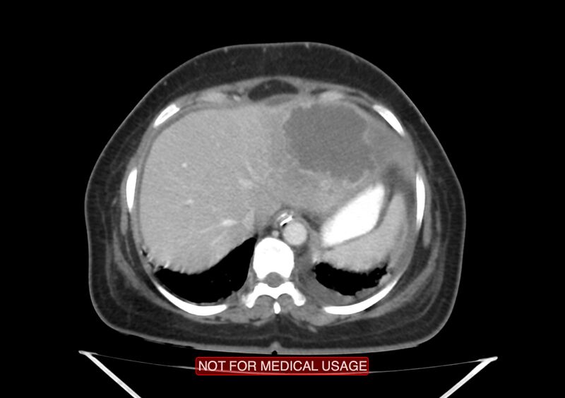 File:Amoebic enterocolitis with liver abscess (Radiopaedia 35100-36609 A 13).jpg