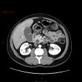 Ampullary carcinoma (Radiopaedia 56396-63056 B 33).jpg