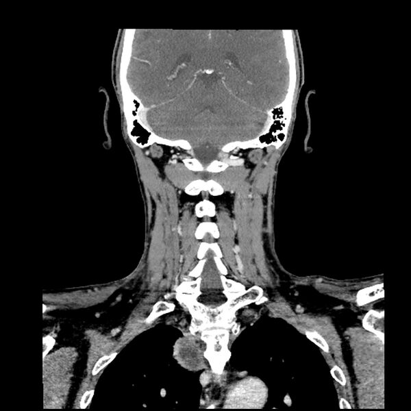 File:Anaplastic thyroid carcinoma (Radiopaedia 79087-92034 A 85).jpg