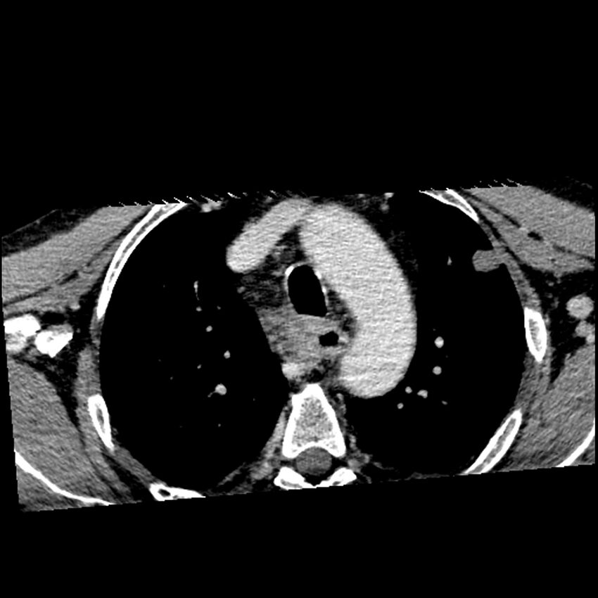 Anaplastic thyroid carcinoma (Radiopaedia 79087-92034 B 7).jpg
