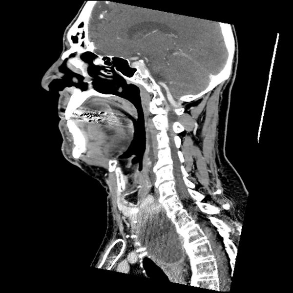 File:Anaplastic thyroid carcinoma (Radiopaedia 79087-92034 C 50).jpg