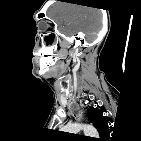 File:Anaplastic thyroid carcinoma (Radiopaedia 79087-92034 C 64).jpg
