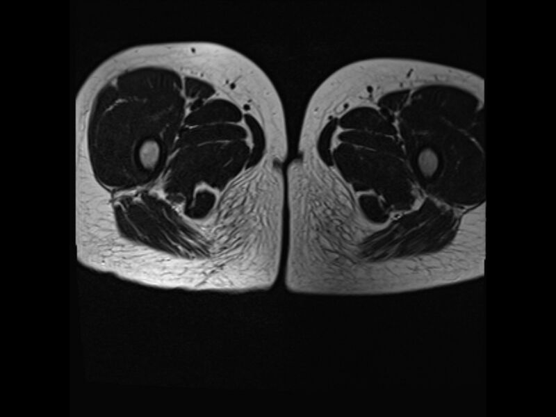 File:Androgen insensitivity syndrome (Radiopaedia 42046-45081 Axial T2 10).jpg