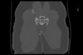 Aneurysmal bone cyst of ischium (Radiopaedia 25957-26094 Coronal bone window 43).png