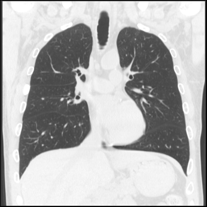 Angioinvasive aspergillosis (Radiopaedia 43957-47466 Coronal lung window 53).jpg