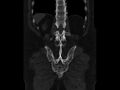 Ankylosing spondylitis (Radiopaedia 44609-48357 Coronal bone window 82).jpg