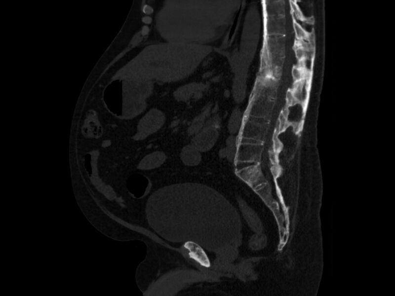 File:Ankylosing spondylitis (Radiopaedia 44609-48357 Sagittal bone window 57).jpg