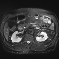Annular pancreas (Radiopaedia 38292-40320 Axial T2 fat sat 17).png