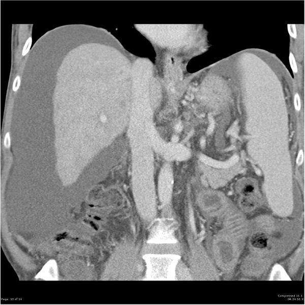 File:Annular pancreas and cirrhosis (Radiopaedia 24561-24843 B 13).jpg