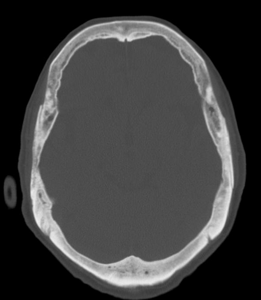 File:Anomalous intracranial venous drainage (Radiopaedia 28161-28418 Axial 14).png