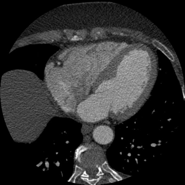 File:Anomalous origin of left circumflex artery from right coronary sinus (Radiopaedia 72563-83117 B 110).jpg