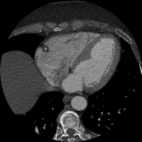 File:Anomalous origin of left circumflex artery from right coronary sinus (Radiopaedia 72563-83117 B 115).jpg