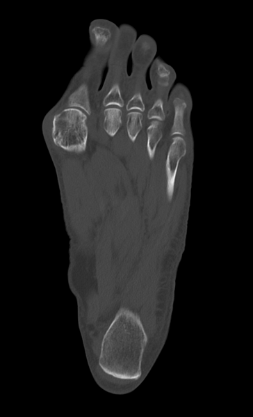 File:Anterior calcaneal process fracture (Radiopaedia 47384-51989 Axial bone window 26).png