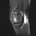 Anterior cruciate ligament tear - pediatric (Radiopaedia 62152-70260 Sagittal PD fat sat 9).jpg