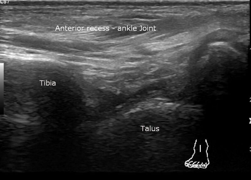 File:Anterior talofibular ligament injury (Radiopaedia 53338-59320 A 1).jpg