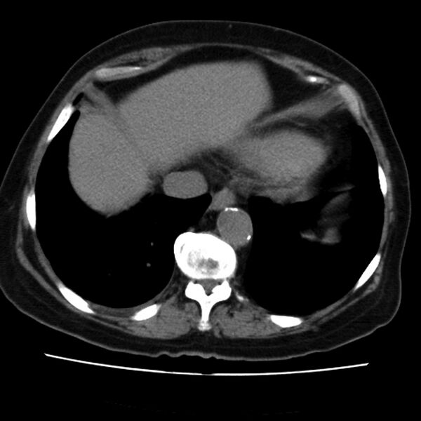 File:Aortic arch pseudoaneurysm (Radiopaedia 8534-9368 Axial non-contrast 58).jpg