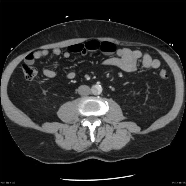 File:Aortic dissection- Stanford A (Radiopaedia 37759-39664 A 116).jpg