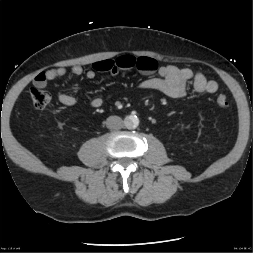 Aortic dissection- Stanford A (Radiopaedia 37759-39664 A 116).jpg
