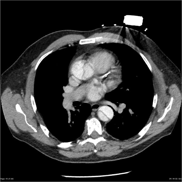 File:Aortic dissection- Stanford A (Radiopaedia 37759-39664 A 34).jpg