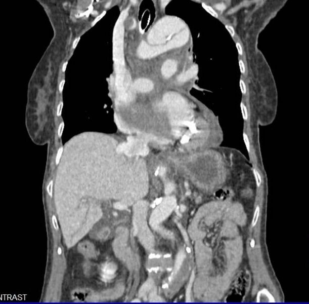 File:Aortic dissection - Stanford type A (Radiopaedia 20760-20675 B 3).jpg