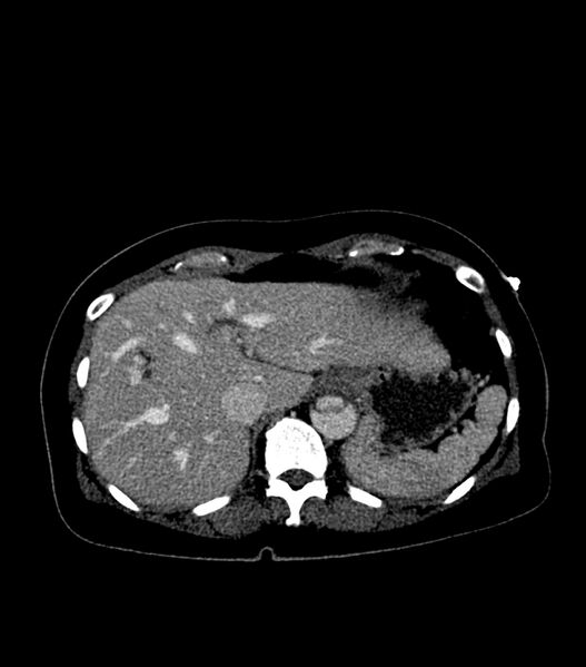 File:Aortic dissection with renal ischemia (Radiopaedia 76573-88338 B 23).jpg