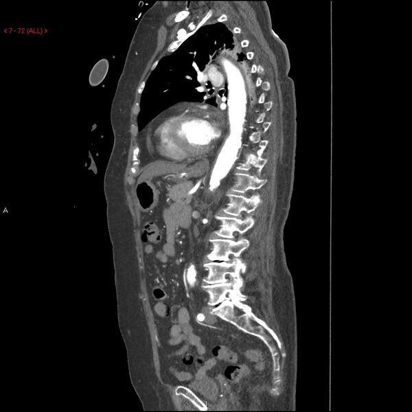File:Aortic intramural hematoma (Radiopaedia 27746-28001 C 41).jpg