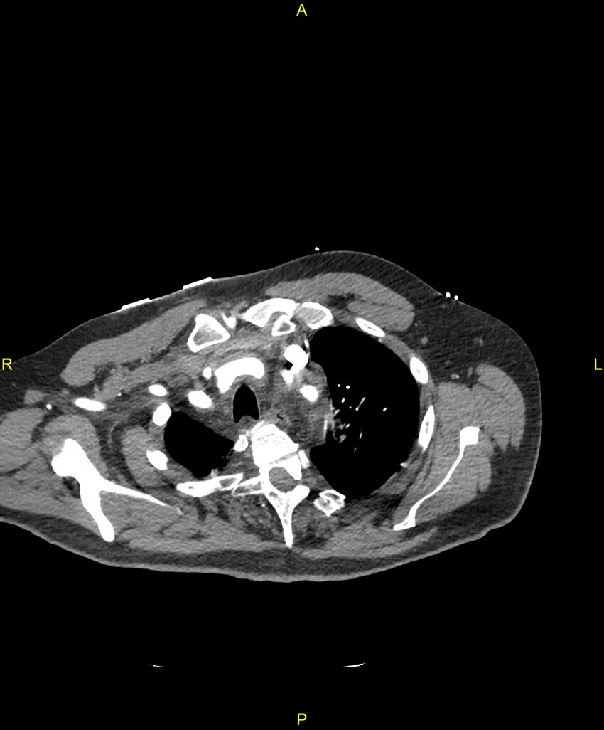 Aortic rupture (Radiopaedia 88822-105594 B 42).jpg