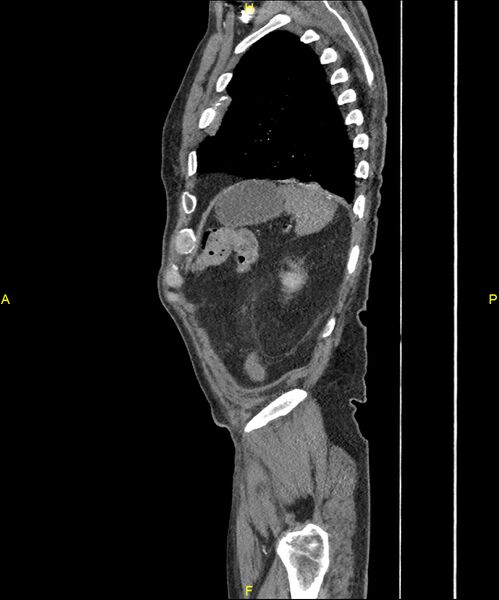 File:Aortoenteric fistula (Radiopaedia 84308-99603 C 291).jpg